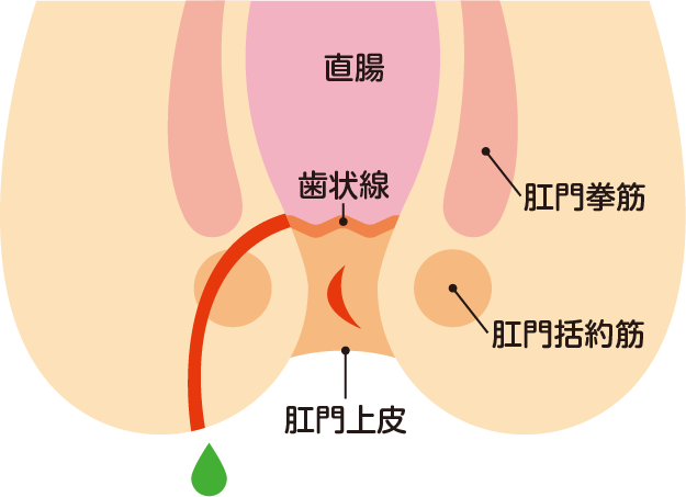 痔瘻（痔ろう）