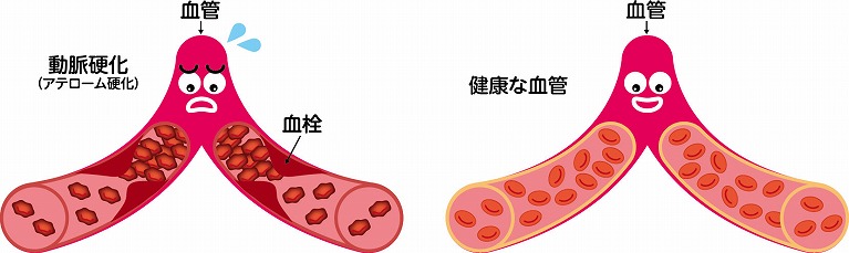 動脈硬化を引き起こす脂質異常症