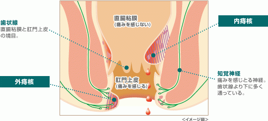 大阪の玉城クリニックの肛門科診療では、女医による痔の日帰り手術を行なっています。