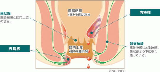 大阪で女性医師による肛門科専門外来 痔の日帰り手術 玉城クリニック