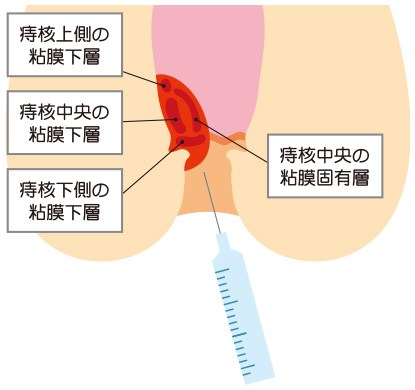 ジオン注射|大阪で女医が行う肛門科専門外来