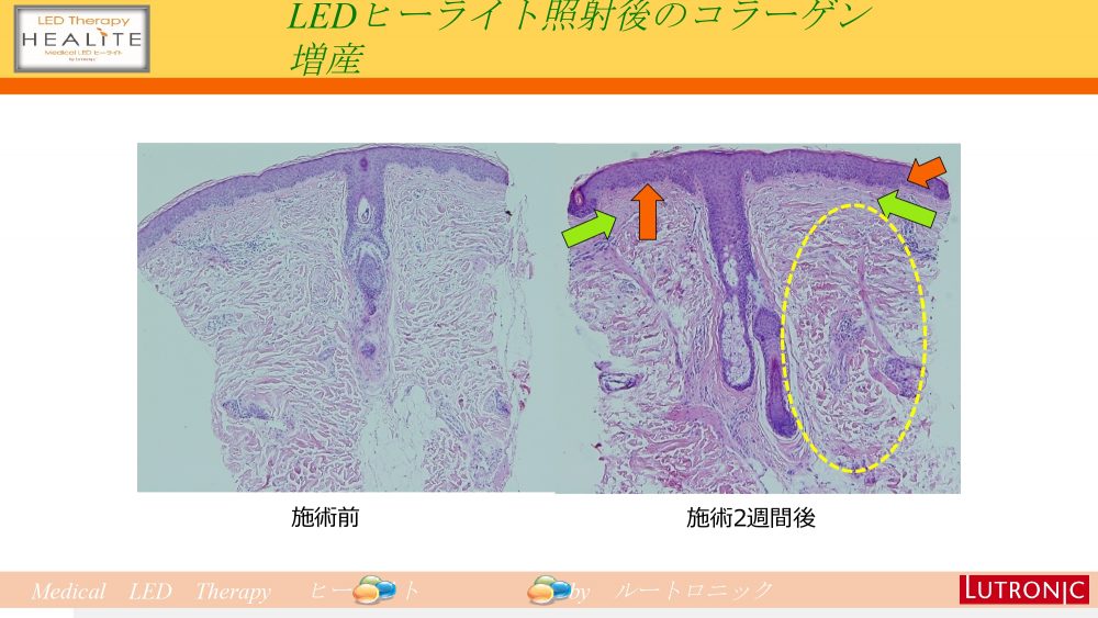 ヒーライトでコラーゲンを増やします。