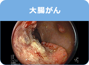 大腸がん