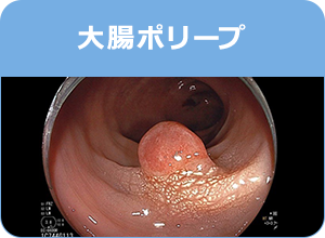 大腸ポリープ