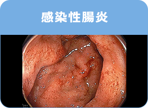 感染症腸炎