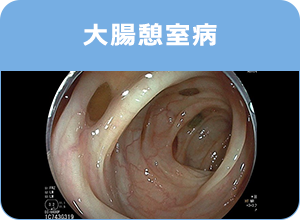 大腸憩室病