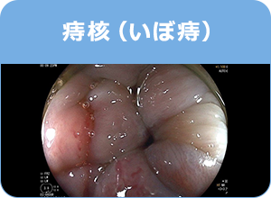 痔核（いぼ痔）