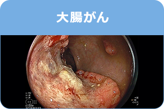 大腸がん