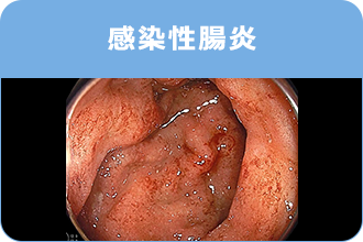 感染症腸炎