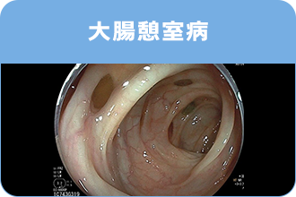 大腸憩室病