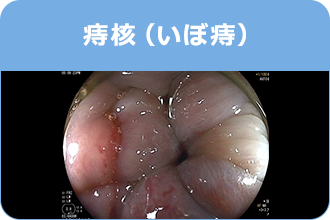 痔核（いぼ痔）